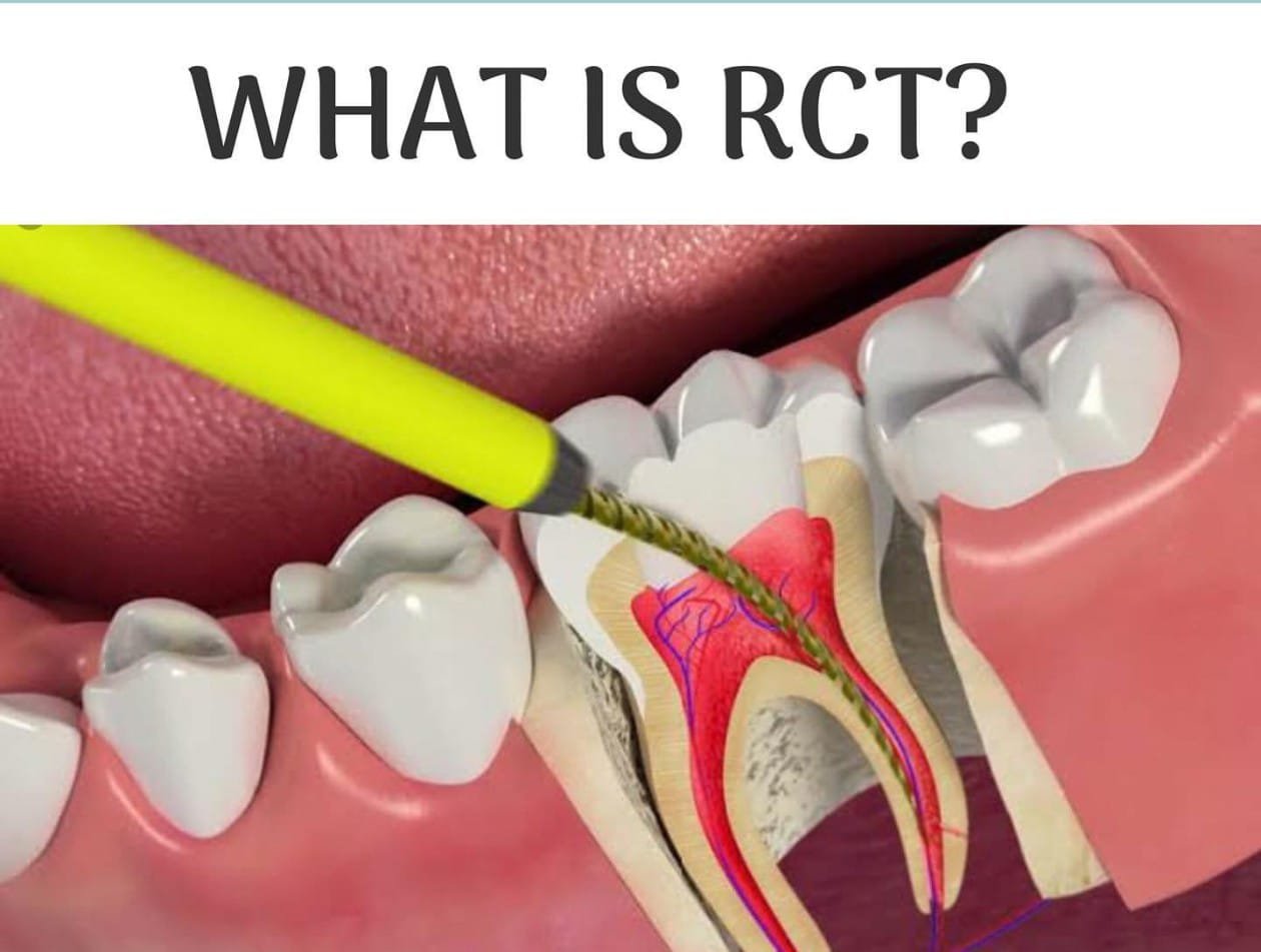 Root canal treatment dental procedure illustration