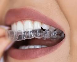 Invisalign clear aligners teeth straightening