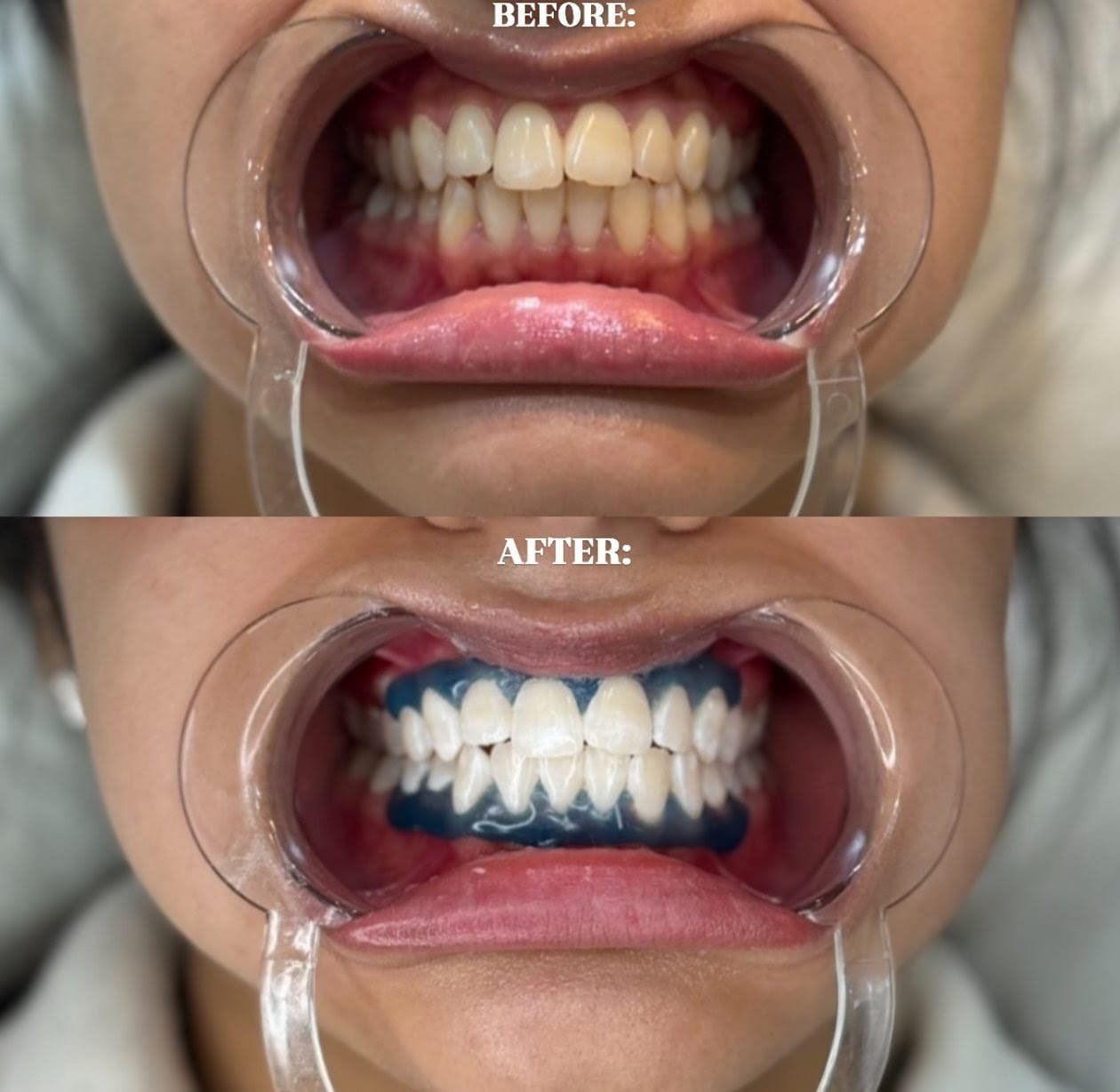 Teeth Whitening
