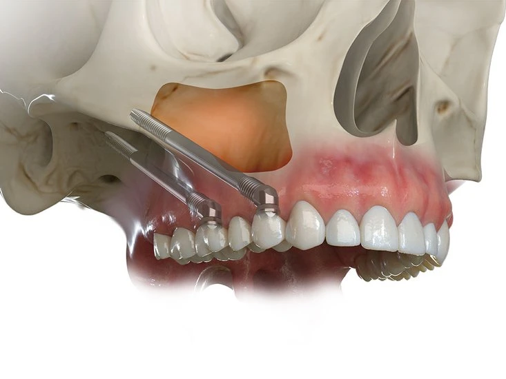 Zygomatic Dental Implants