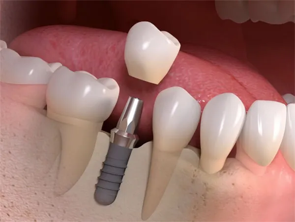 Immediate Loading Dental Implants