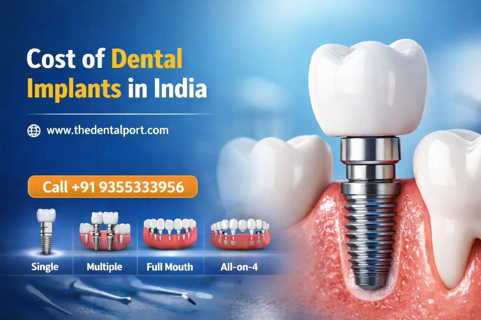 Dental Implant Cost in India 2026 – Complete Patient Guide