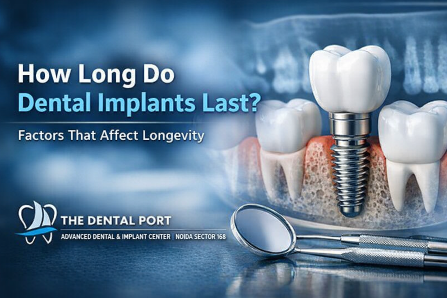 How Long Do Dental Implants Last? Factors That Affect Longevity
