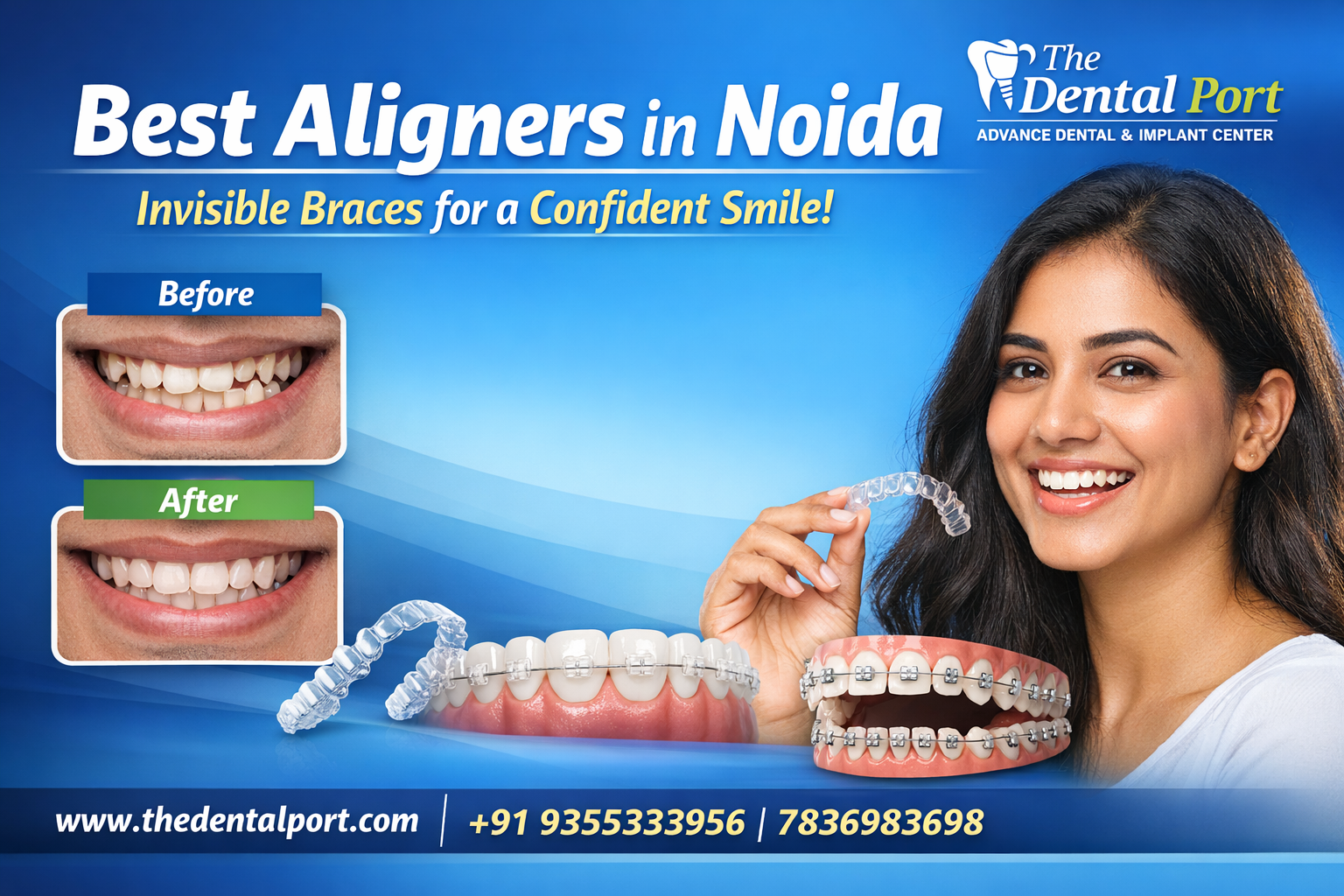 Best Aligners in Noida: Types of Invisible Braces and Clear Aligners