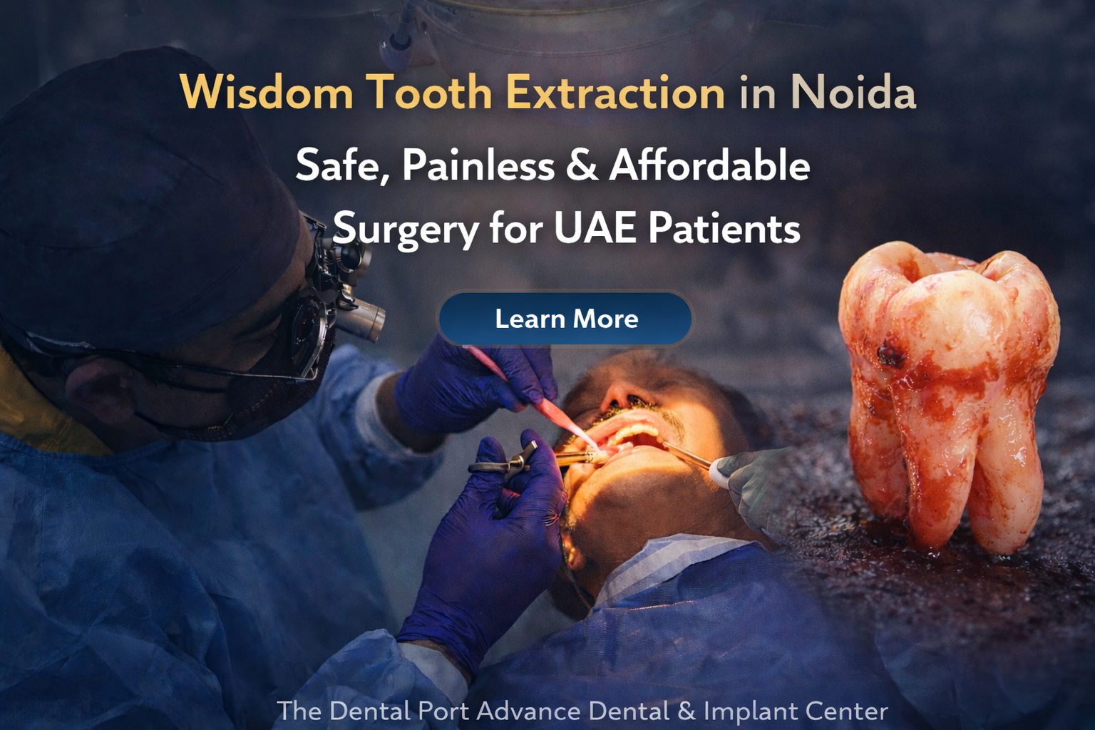 Wisdom Tooth Extraction Surgery in Noida: Why UAE Patients Choose The Dental Port