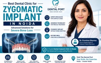 Best Dental Clinic for Zygomatic Implant in Noida