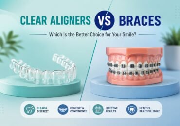 Clear Aligners in Noida