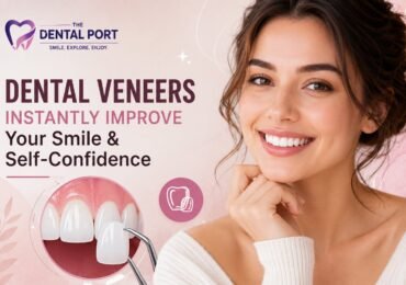 Dental Veneers in Noida