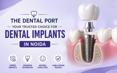 Trusted Dental Implant Clinic in Greater Noida