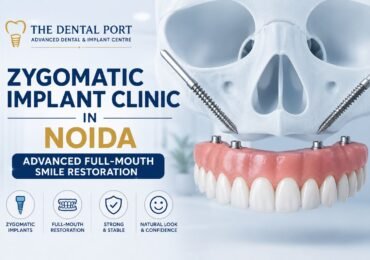 Zygomatic Implant Clinic in Noida