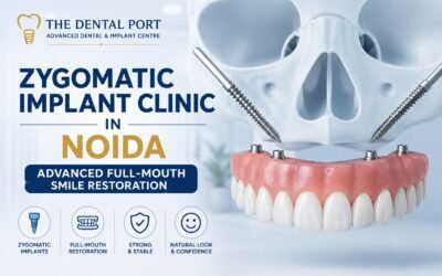 Zygomatic Implant Clinic in Noida