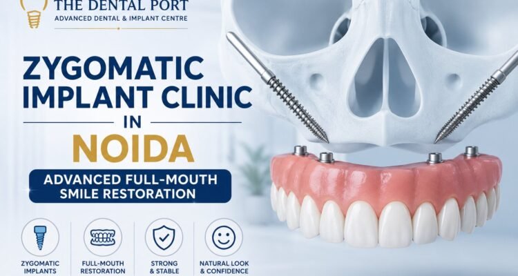 Zygomatic Implant Clinic in Noida