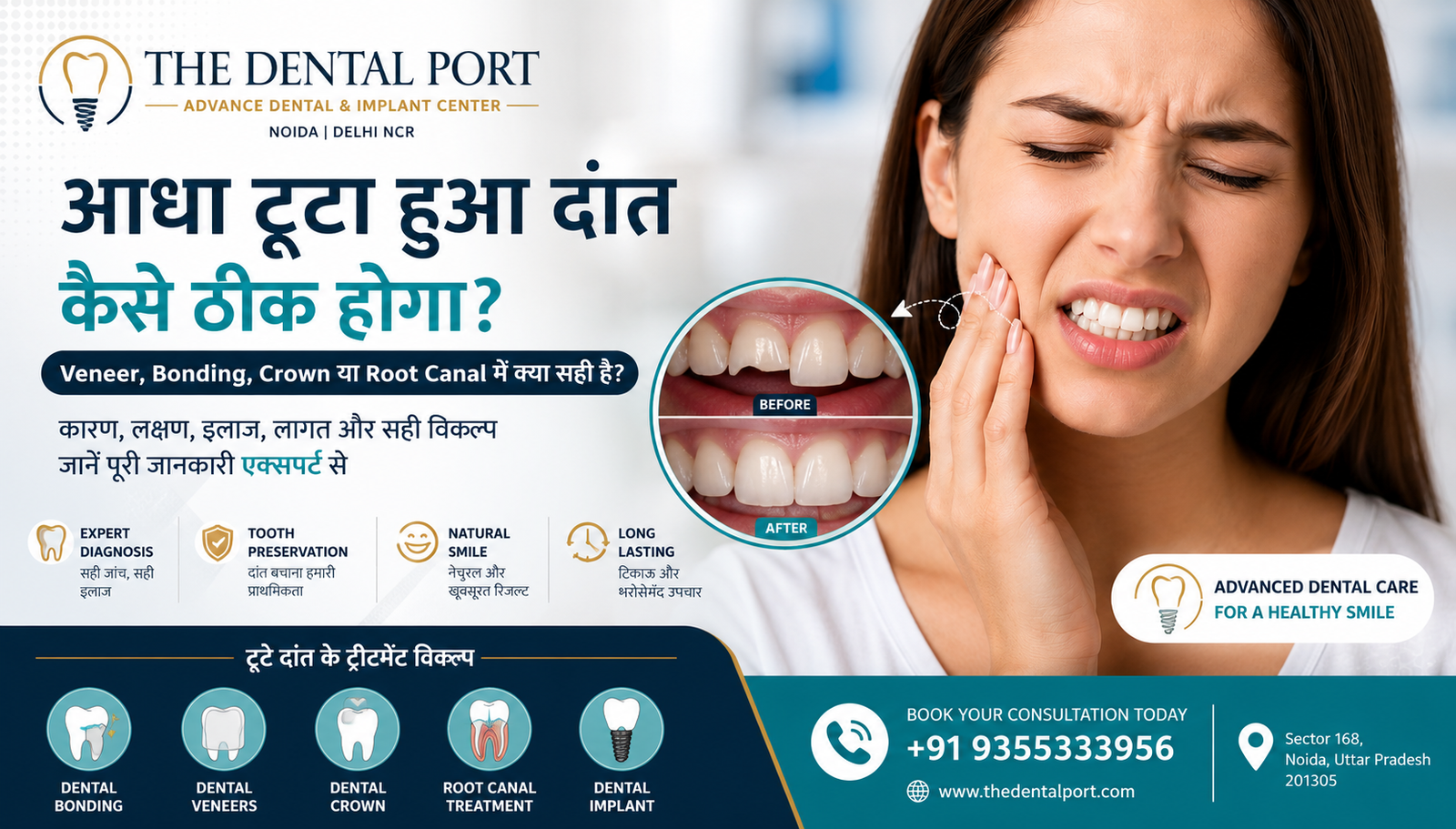 आधा टूटा हुआ दांत कैसे ठीक होगा? Veneer, Bonding, Crown या Root Canal में क्या सही है?
