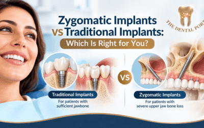 Zygomatic Implants in Noida