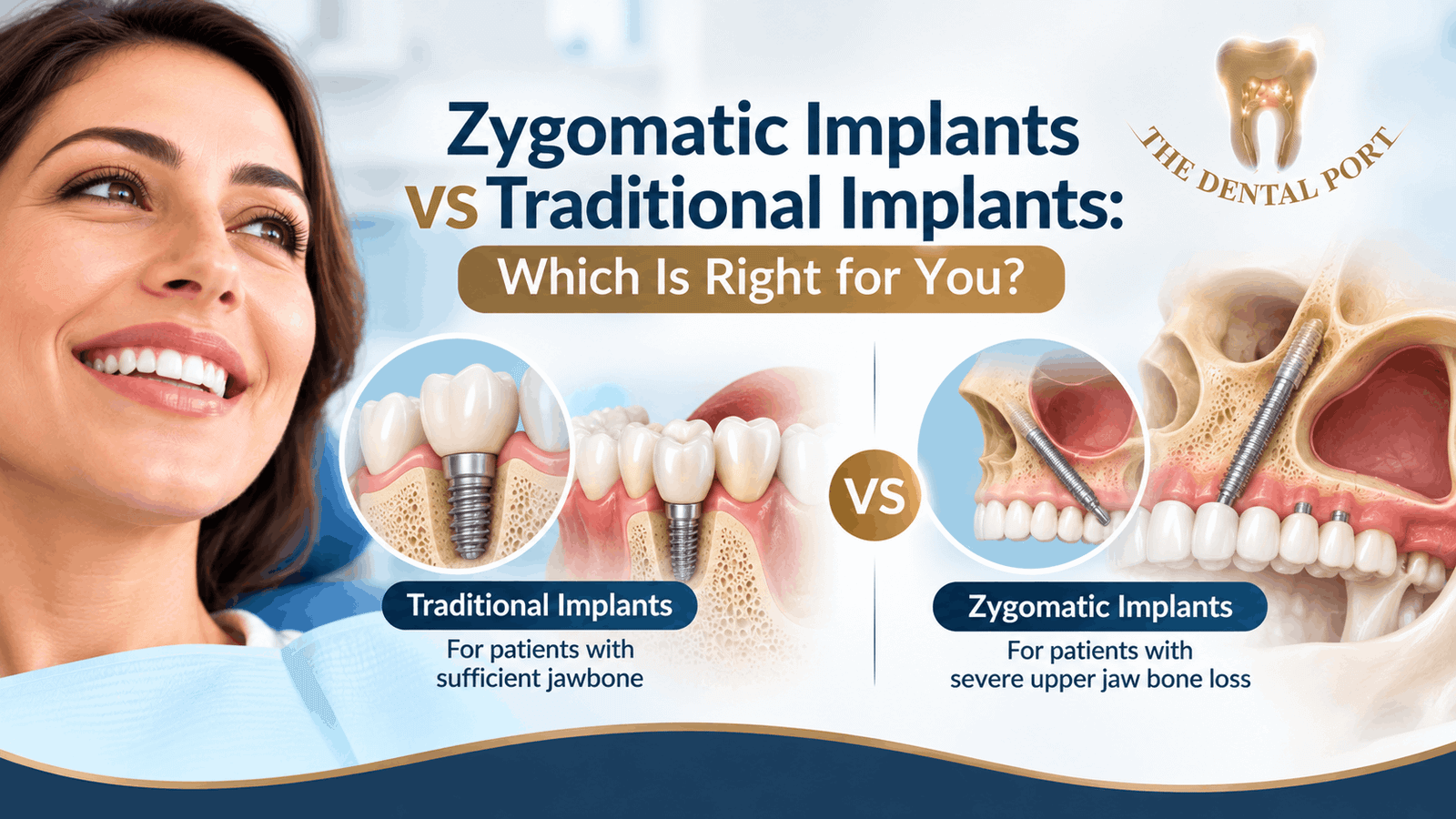 Zygomatic Implants in Noida