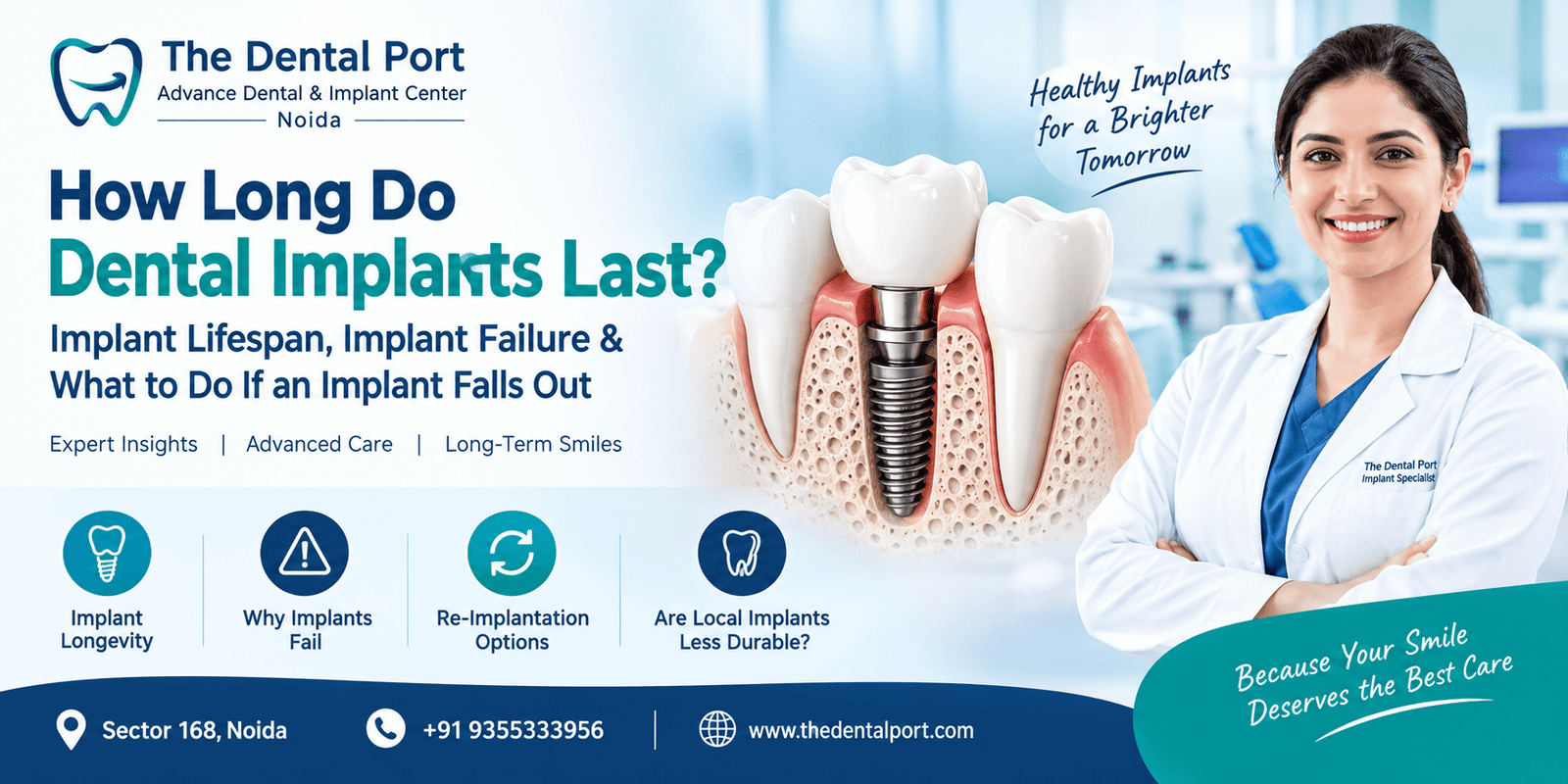 How Long Do Dental Implants Last? Implant Lifespan, Implant Failure & What to Do If an Implant Falls Out