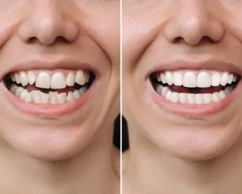invisalign-before-and-after-crowding